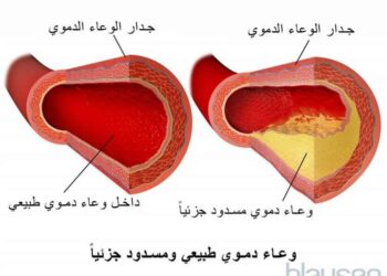 تصلب الشرايين ماهو التصلب العصيدي