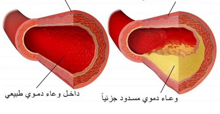 تصلب الشرايين ماهو التصلب العصيدي